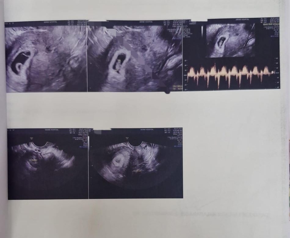 An early pregnancy scan confirming a heartbeat