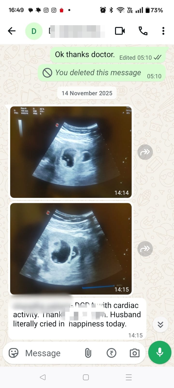 An early pregnancy scan showing a twin pregnancy with two sacs