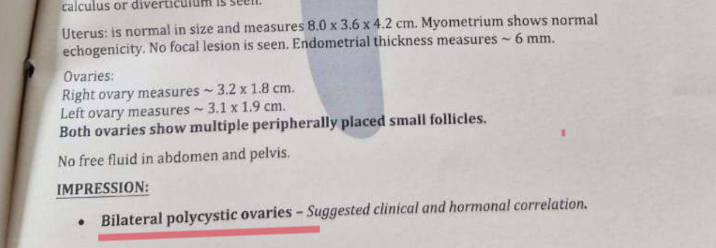 Ultrasound impression: bilateral polycystic ovaries with multiple peripherally placed small follicles