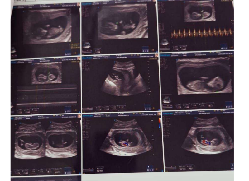 Pregnancy scan confirming a healthy pregnancy