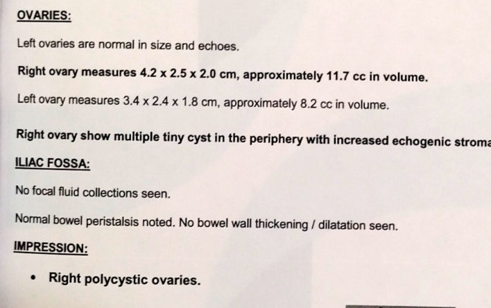 Ultrasound report showing right polycystic ovaries with multiple tiny cysts in the periphery and increased echogenic stroma