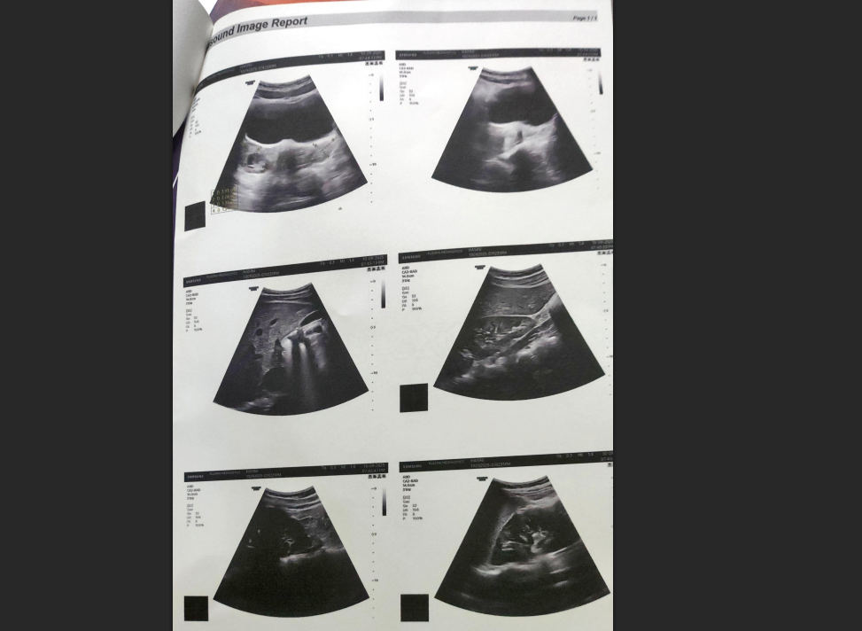 Harini's ultrasound showing polycystic ovarian pattern bilaterally