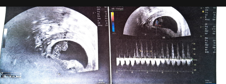 CRL (crown-rump length) measurement on the ultrasound