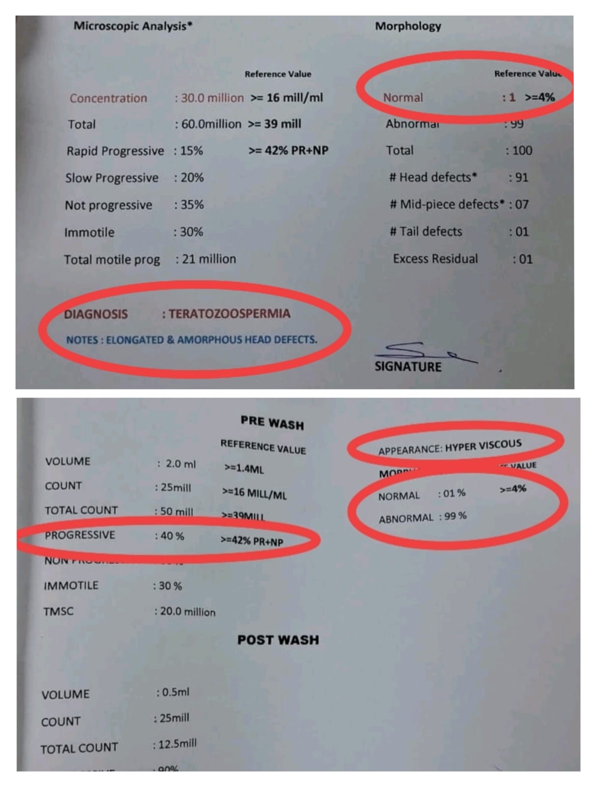Husband's semen analysis showing teratozoospermia: 1% normal morphology, hyper-viscous sample